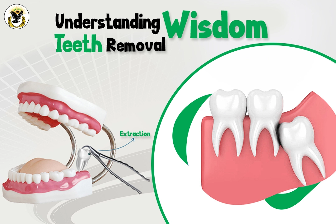Understanding wisdom teeth removal
